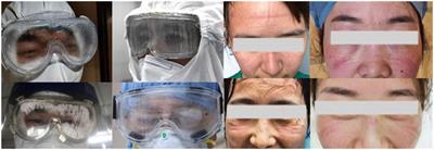 Emphasis on heat strain to the ocular surface: A functional and clinical study of a modified goggle